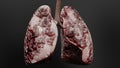 Pneumonia illness, healthy lungs and disease lungs, Human Lungs cancer, Cigarette smokers Lung disease, asthma infection