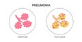 Pneumonia infection poster