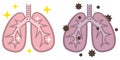 Pneumonia infection medical concept as human lungs infected by virus and bacteria as a lung disease diagnosis with flat