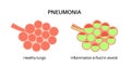 Pneumonia infection poster