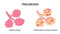 Pneumonia infection poster