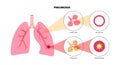 Pneumonia infection poster