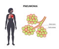 Pneumonia infection poster