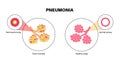 Pneumonia infection poster