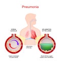 Pneumonia. Lung infection. Alveoli with fluid