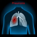 Pneumonia. Lungs, bronchi and Trachea into x-ray