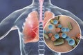 Pneumonia, medical concept, illustration showing human lungs and close-up view of microbes in lungs Royalty Free Stock Photo