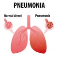 Pneumonia. Normal and infected alveoli. Healthy and ilness lungs cartoon flat icon for web design isolated on white background. Sc