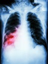 Pneumonia with respiratory failure Royalty Free Stock Photo