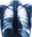 Pneumonia & x28; film chest x-ray show alveolar infiltrate at right middle lung & x29;