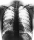 Pneumonia & x28; film chest x-ray show alveolar infiltrate at right middle lung & x29;