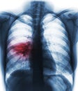 Pneumonia & x28; film chest x-ray show alveolar infiltrate at right middle lung & x29; Royalty Free Stock Photo