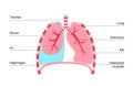 Pneumothorax anatomical poster