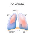 Pneumothorax. Collapsed lung. Royalty Free Stock Photo