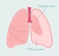 Pneumothorax of human lungs. Collapsed lung - vector anatomical scheme