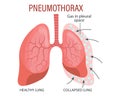 Pneumothorax, a lung disease. Healthcare. Medical infographic banner, illustration
