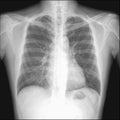 pneumothorax seen in chest radiography which want to intercostral drainage