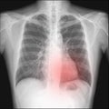 pneumothorax seen in chest radiography which want to intercostral drainage.The red dots pointing.