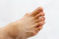 Foot with gout on the bones isolated Royalty Free Stock Photo
