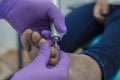 Podiatrist is removing a corn from a patient via drilling tool Royalty Free Stock Photo