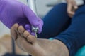 Podiatrist is removing a corn from a patient via drilling tool Royalty Free Stock Photo