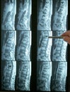 Pointing to an mri of lumbar spine Royalty Free Stock Photo