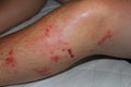 Poison Ivy Rash Royalty Free Stock Photo