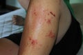 Poison Ivy Rash Royalty Free Stock Photo