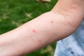 poison ivy spots and blisters on woman`s arm