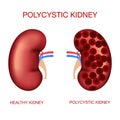 Polycystic kidney disease.Normal and polycystic kidneys.Realistic organs