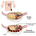 Polycystic ovarian syndrome medical  illustration Royalty Free Stock Photo