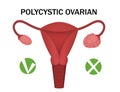 Polycystic ovary disease and a healthy ovary. medical infographics. Vector illustration