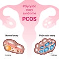 Polycystic ovary syndrome PCOS, hormonal diagnose, medical illustration