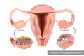 Polycystic Ovary Syndrome or PCOS. Multiple immature follicles or Ovarian cysts Royalty Free Stock Photo