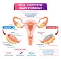 Polycystic ovary syndrome vector illustration. Labeled reproductive disease