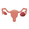 Polycystic ovary vector illustration