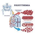 Polycythemia vera blood cancer type with increased red cells outline diagram