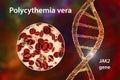 Polycythemia vera, a rare slow-growing blood cancer with an increase in the number of red blood cells