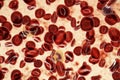 Polycythemia vera, a rare slow-growing blood cancer with an increase in the number of red blood cells