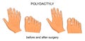 Polydactyly before and after surgery