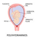 Polyhydramnios. excess of amniotic fluid in the amniotic sac.