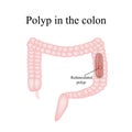 Polyp in the intestine. Polyp in the colon. Vector