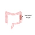 Polyp in the intestine. Polyp in the colon. Vector