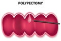 Polypectomy