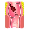 Polyps in the rectum. The structure of the rectum of the intestine. Types of polyps in the colon. Infographics. Vector