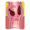 Polyps in the rectum. The structure of the rectum of the intestine. Types of polyps in the colon. Infographics. Vector