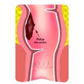 Polyps in the rectum. The structure of the rectum of the intestine. Types of polyps in the colon. Infographics. Vector