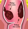 Polyps in the rectum. The structure of the rectum of the intestine. Types of polyps in the colon. Infographics. Vector