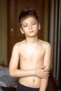Boy with chickenpox Royalty Free Stock Photo