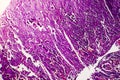 Poorly differentiated intestinal adenocarcinoma , light micrograph Royalty Free Stock Photo